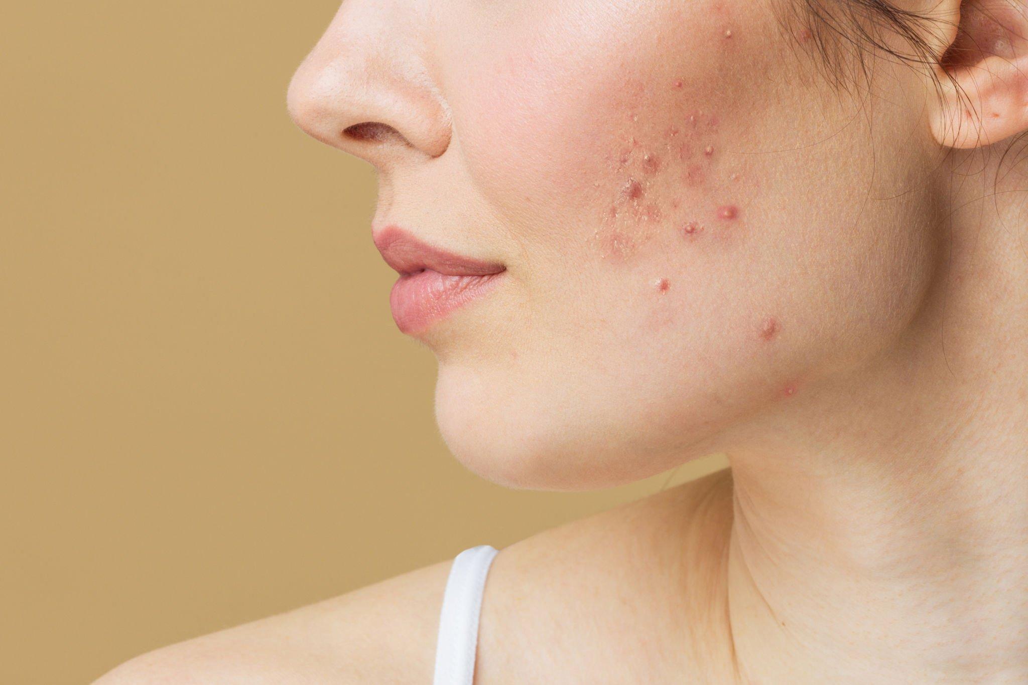 acne-treatment-A S Rao Nagar, Secunderabad-hyderabad
